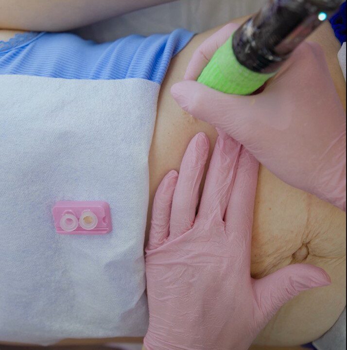 Inkless Scars and Stretch Mark Removal & Revision (ISR). Cosmetic and Mediical Tattoo by Dasha. Permanent makeup and reconstructive tattoo, scalp micro-pigmentation in Christchurch, New Zealand