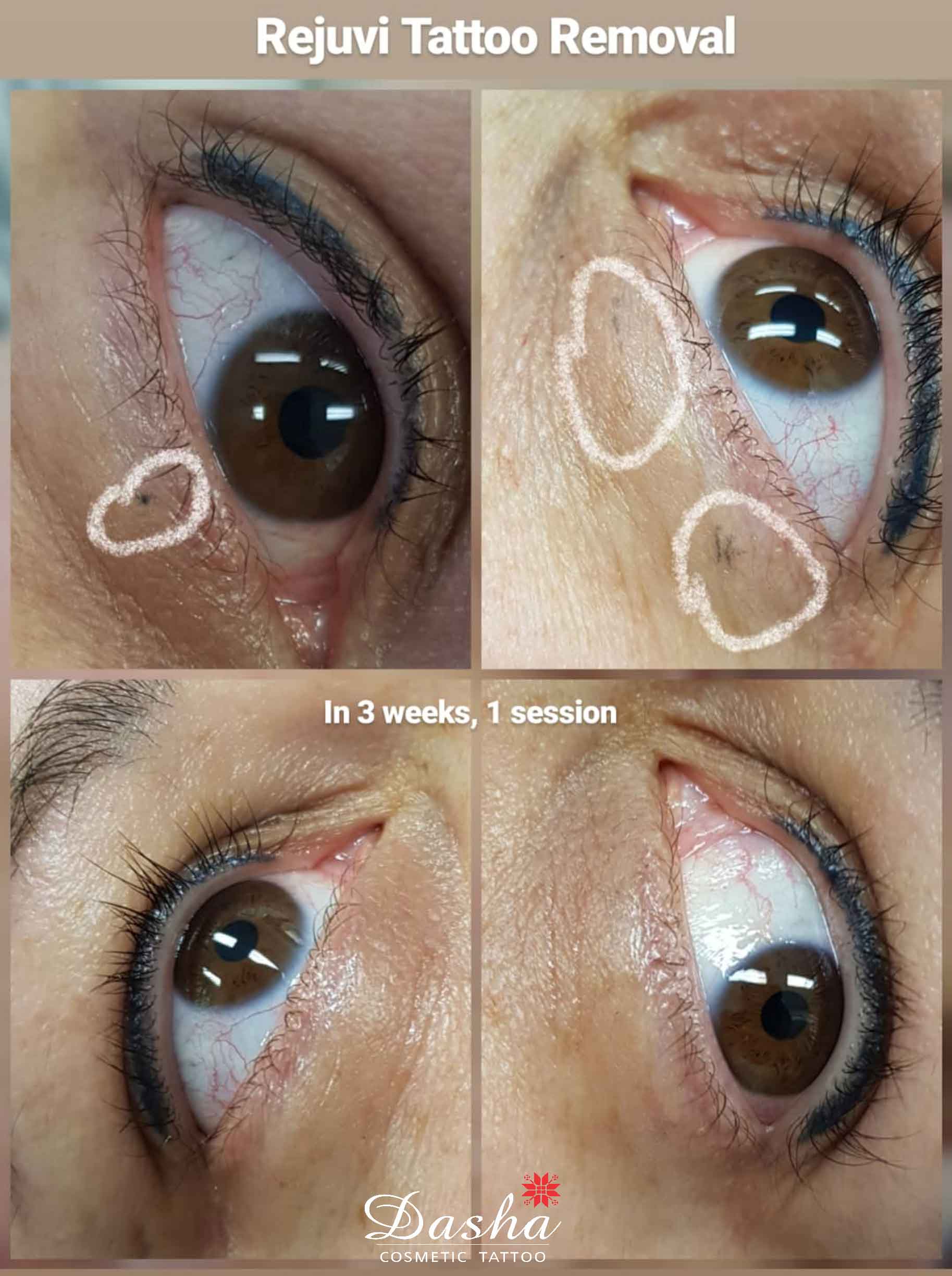 Rejuvi Tattoo Removal. Cosmetic and Mediical Tattoo by Dasha. Permanent makeup and reconstructive tattoo, scalp micro-pigmentation in Christchurch, New Zealand