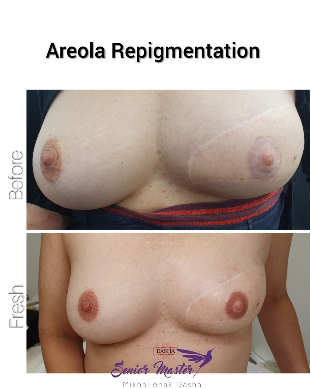 3D Areola Repigmentation, Medical Tattoo. Cosmetic and Mediical Tattoo by Dasha. Permanent makeup and reconstructive tattoo, scalp micro-pigmentation in Christchurch, New Zealand