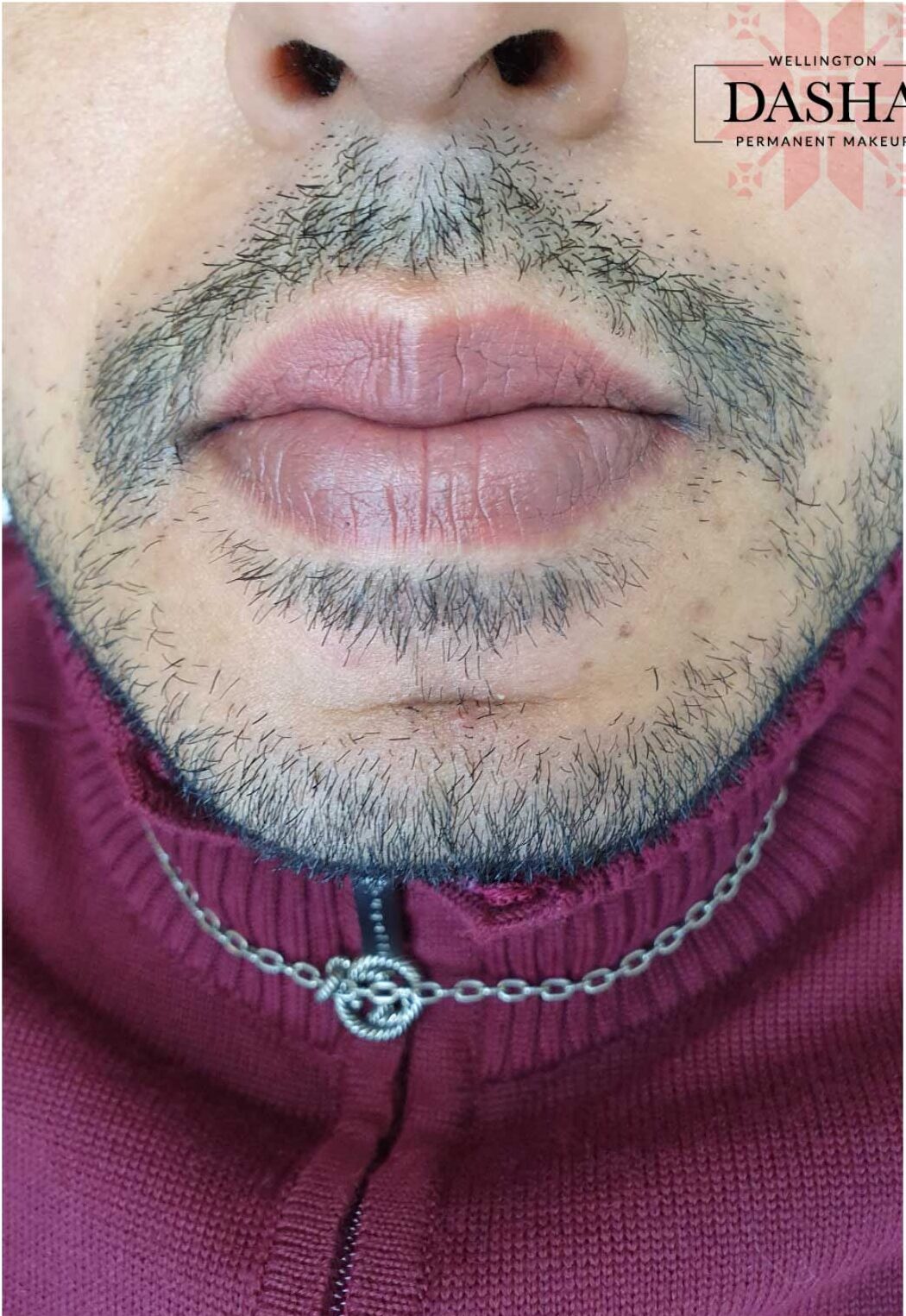 Dark Lip Neutralization. Cosmetic and Mediical Tattoo by Dasha. Permanent makeup and reconstructive tattoo, scalp micro-pigmentation in Christchurch, New Zealand