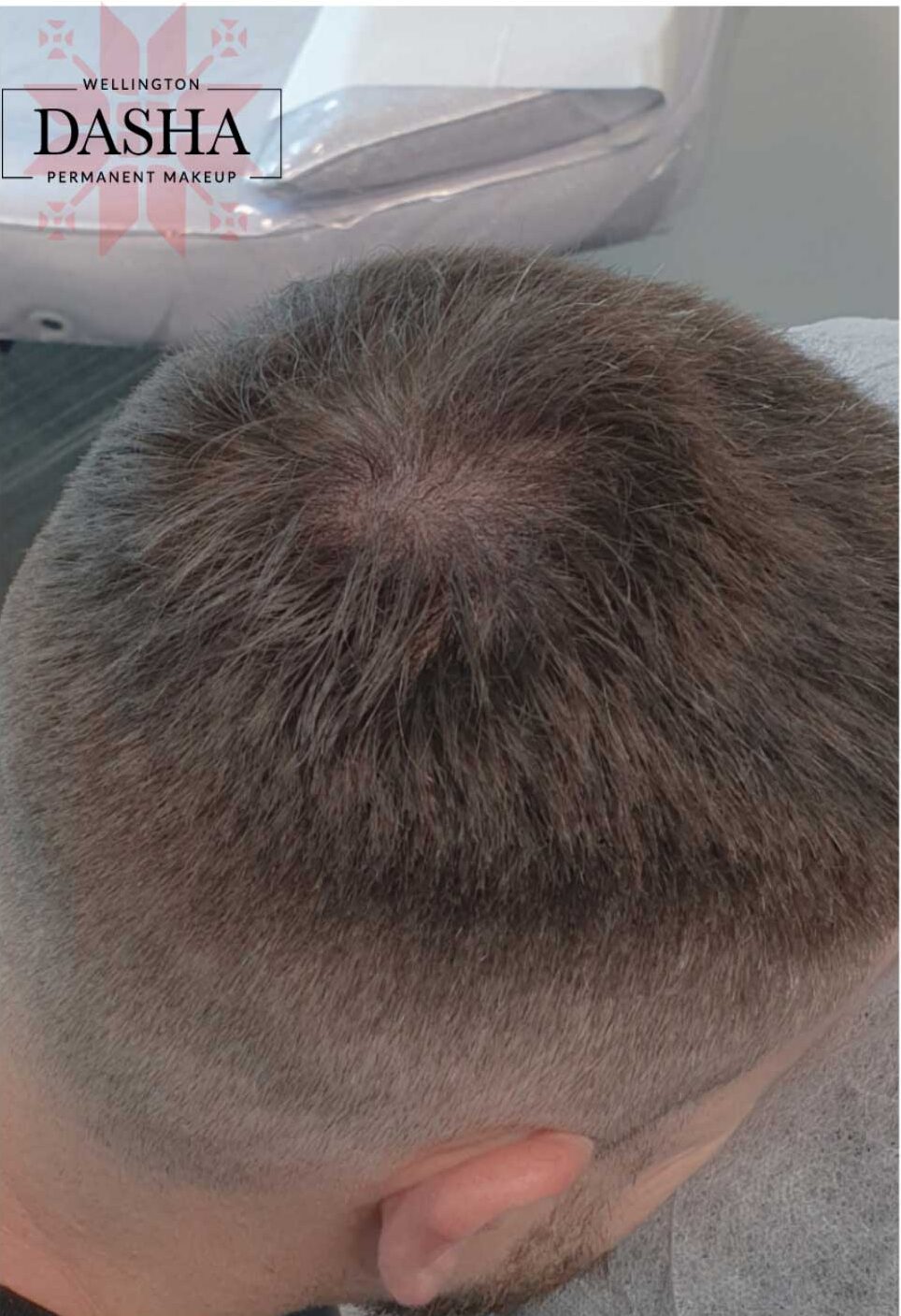 Scalp Micropigmentation. Cosmetic and Mediical Tattoo by Dasha. Permanent makeup and reconstructive tattoo, scalp micro-pigmentation in Christchurch, New Zealand