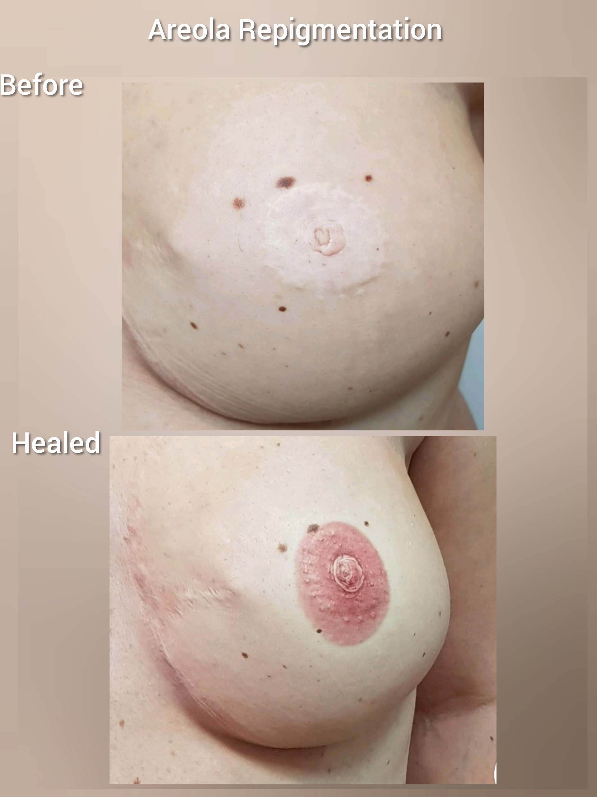 3D Areola Tattoo. Cosmetic and Mediical Tattoo by Dasha. Permanent makeup and reconstructive tattoo, scalp micro-pigmentation in Christchurch, New Zealand