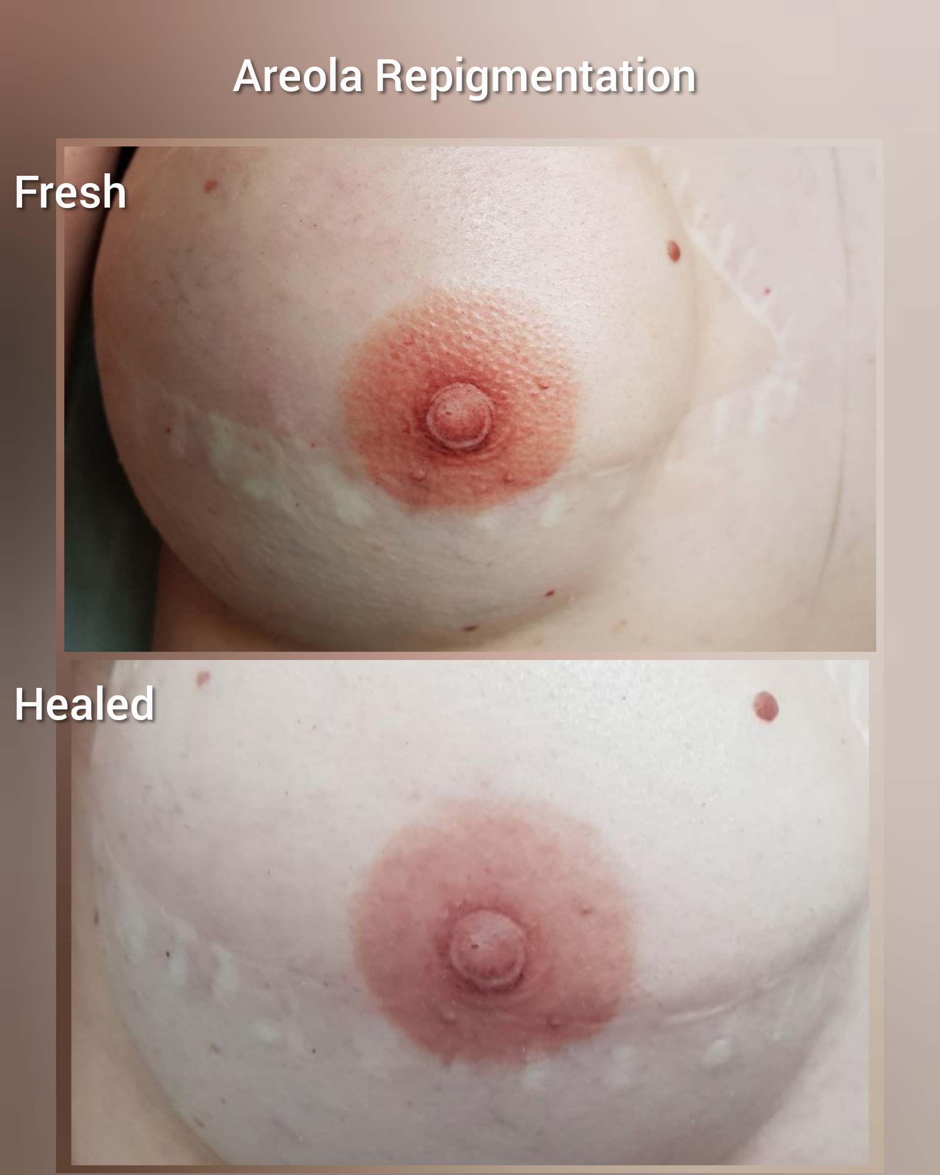 Areola Repigmentation. Cosmetic and Mediical Tattoo by Dasha. Permanent makeup and reconstructive tattoo, scalp micro-pigmentation in Christchurch, New Zealand