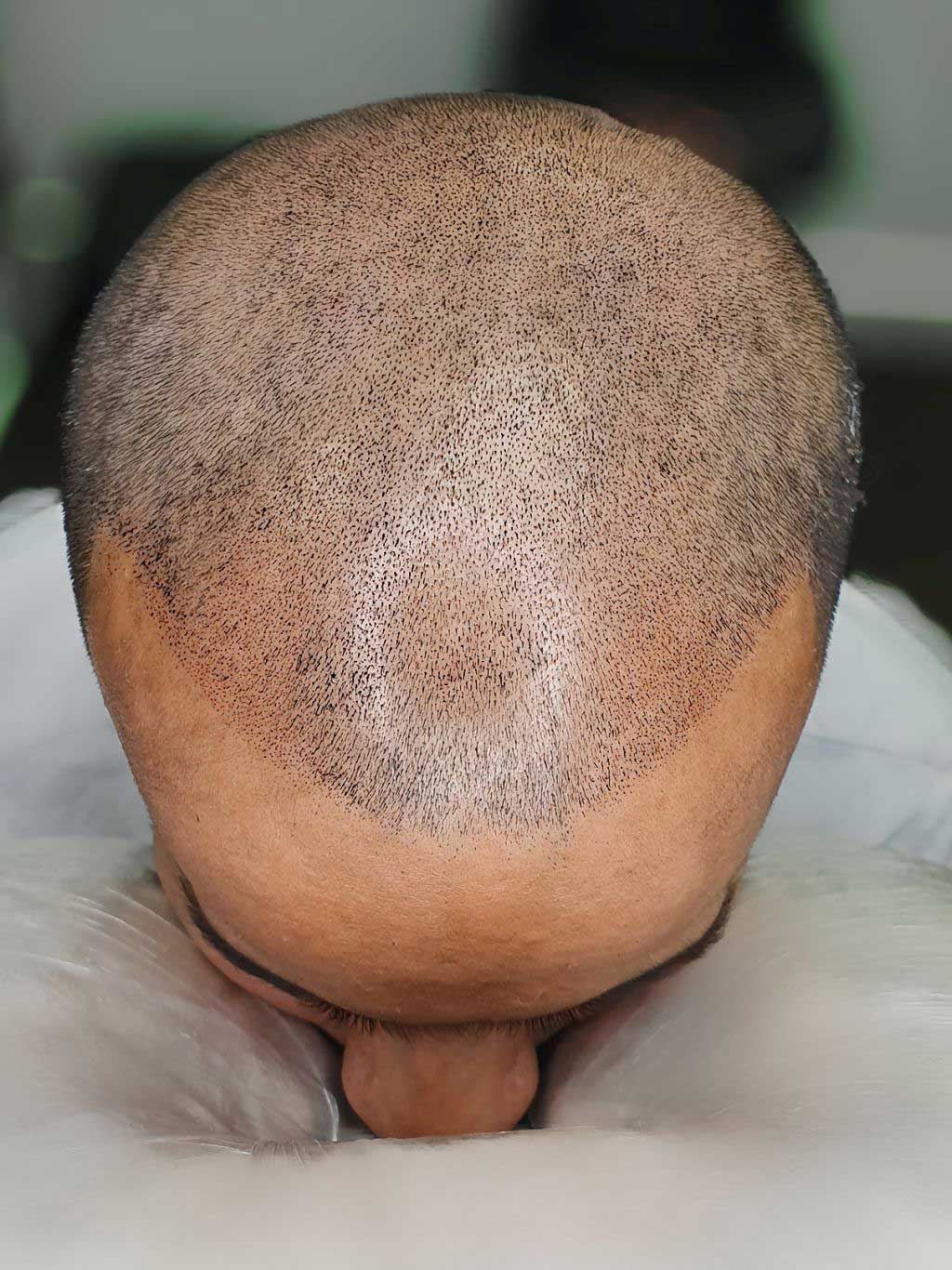Scalp MicroPigmentation (SMP). Cosmetic and Mediical Tattoo by Dasha. Permanent makeup and reconstructive tattoo, scalp micro-pigmentation in Christchurch, New Zealand