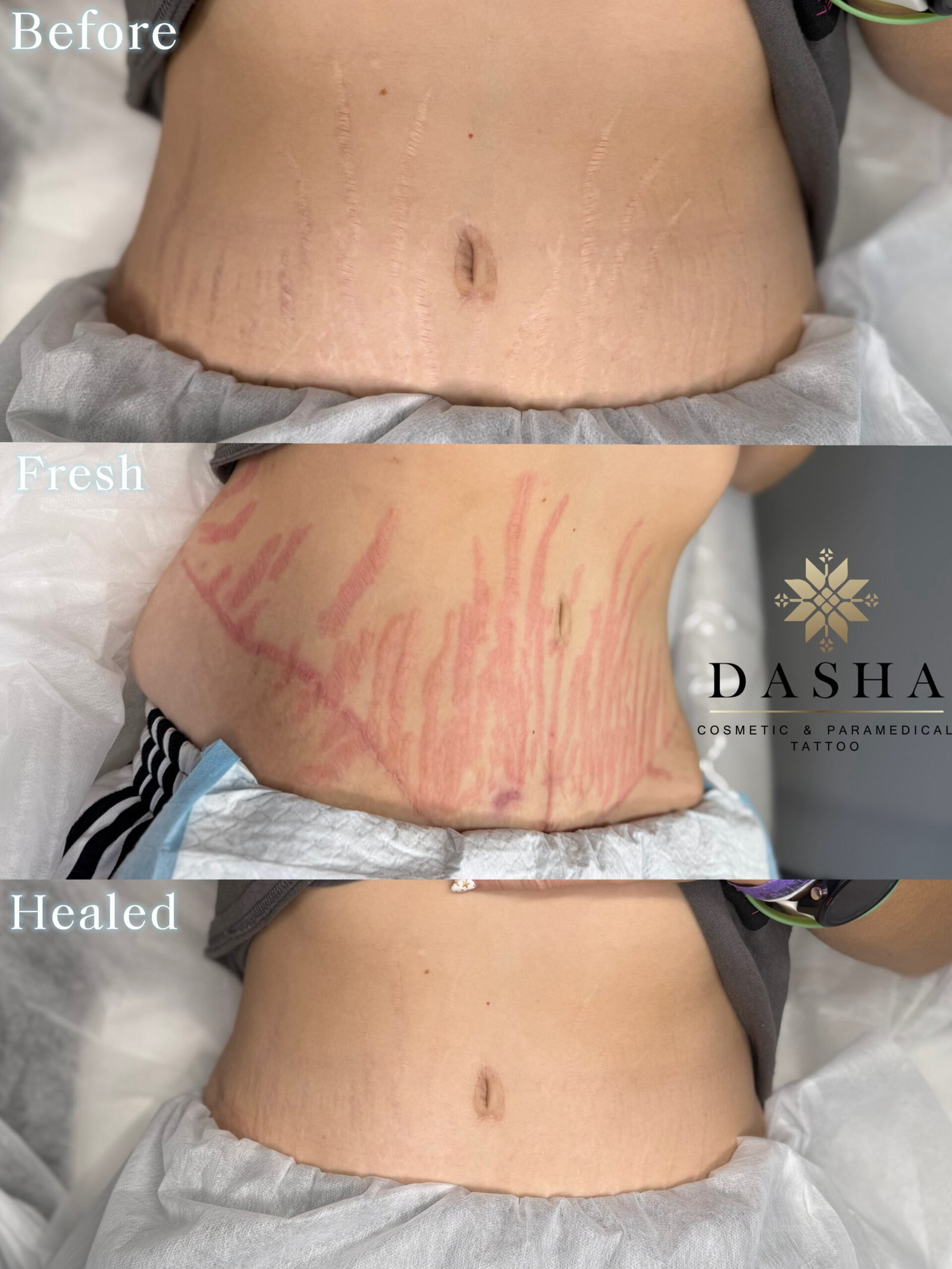 Stretch Marks Camouflage Medical Tattoo. Cosmetic and Mediical Tattoo by Dasha. Permanent makeup and reconstructive tattoo, scalp micro-pigmentation in Christchurch, New Zealand