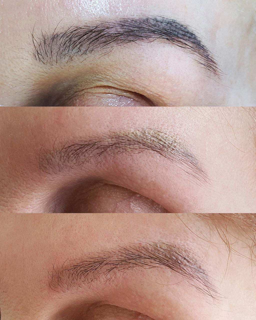 Laser Tattoo Removal. Cosmetic and Mediical Tattoo by Dasha. Permanent makeup and reconstructive tattoo, scalp micro-pigmentation in Christchurch, New Zealand