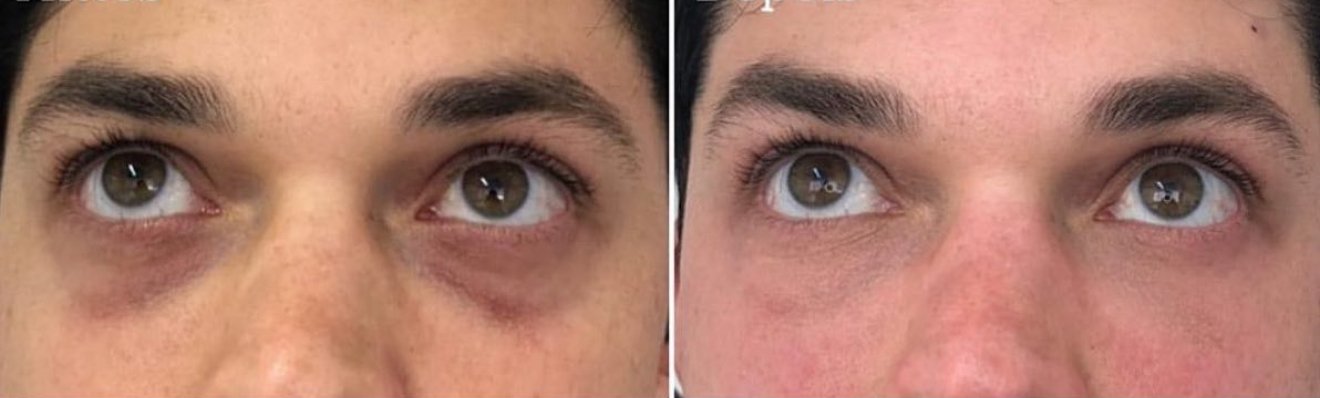 Dark Undereye Conceal Tattoo
