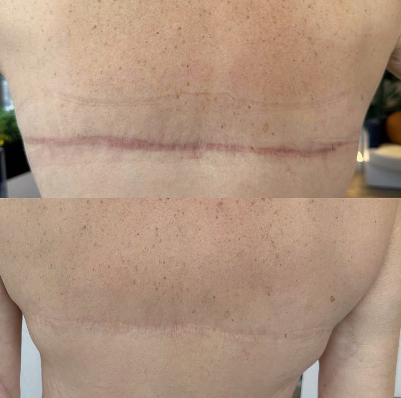 Scar Camoufalge. Cosmetic and Mediical Tattoo by Dasha. Permanent makeup and reconstructive tattoo, scalp micro-pigmentation in Christchurch, New Zealand