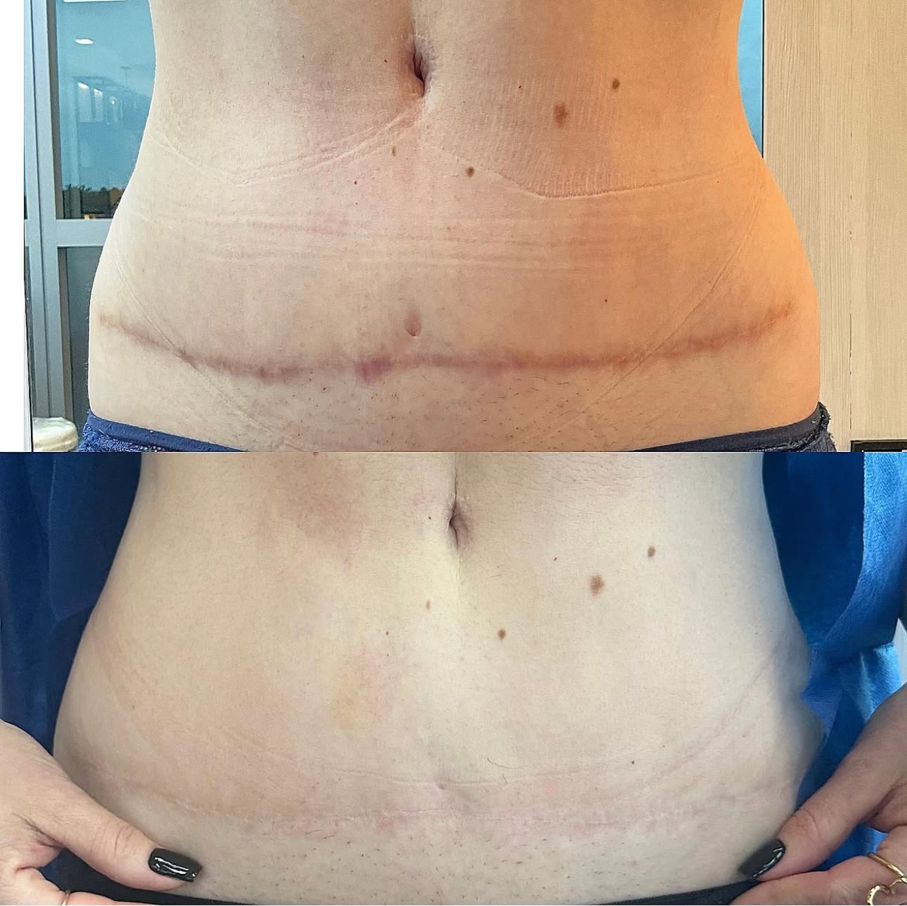 Tummy Tuck Scar Camouflage. Cosmetic and Mediical Tattoo by Dasha. Permanent makeup and reconstructive tattoo, scalp micro-pigmentation in Christchurch, New Zealand