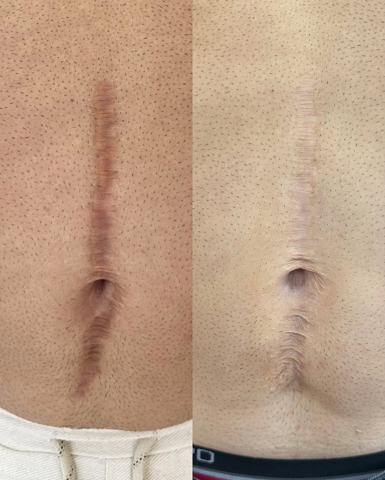 Abdominal surgery scar cover-up. Cosmetic and Mediical Tattoo by Dasha. Permanent makeup and reconstructive tattoo, scalp micro-pigmentation in Christchurch, New Zealand