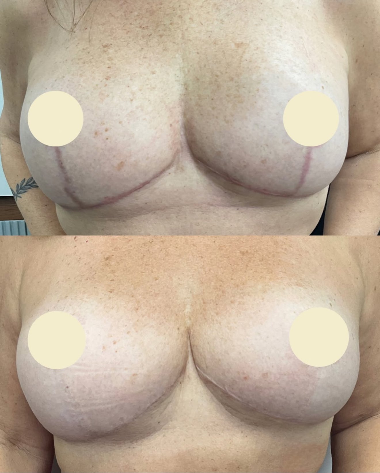 Inframammary Fold Incision Scar Camouflage. Cosmetic and Mediical Tattoo by Dasha. Permanent makeup and reconstructive tattoo, scalp micro-pigmentation in Christchurch, New Zealand