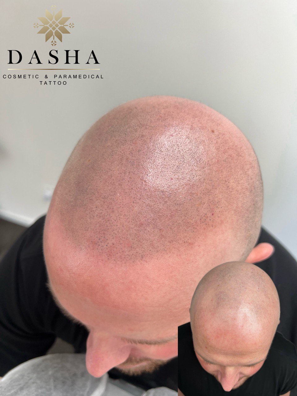 SMP Scalp MIcropigmentation Dasha Cosmetic Tattoo HairTransplant