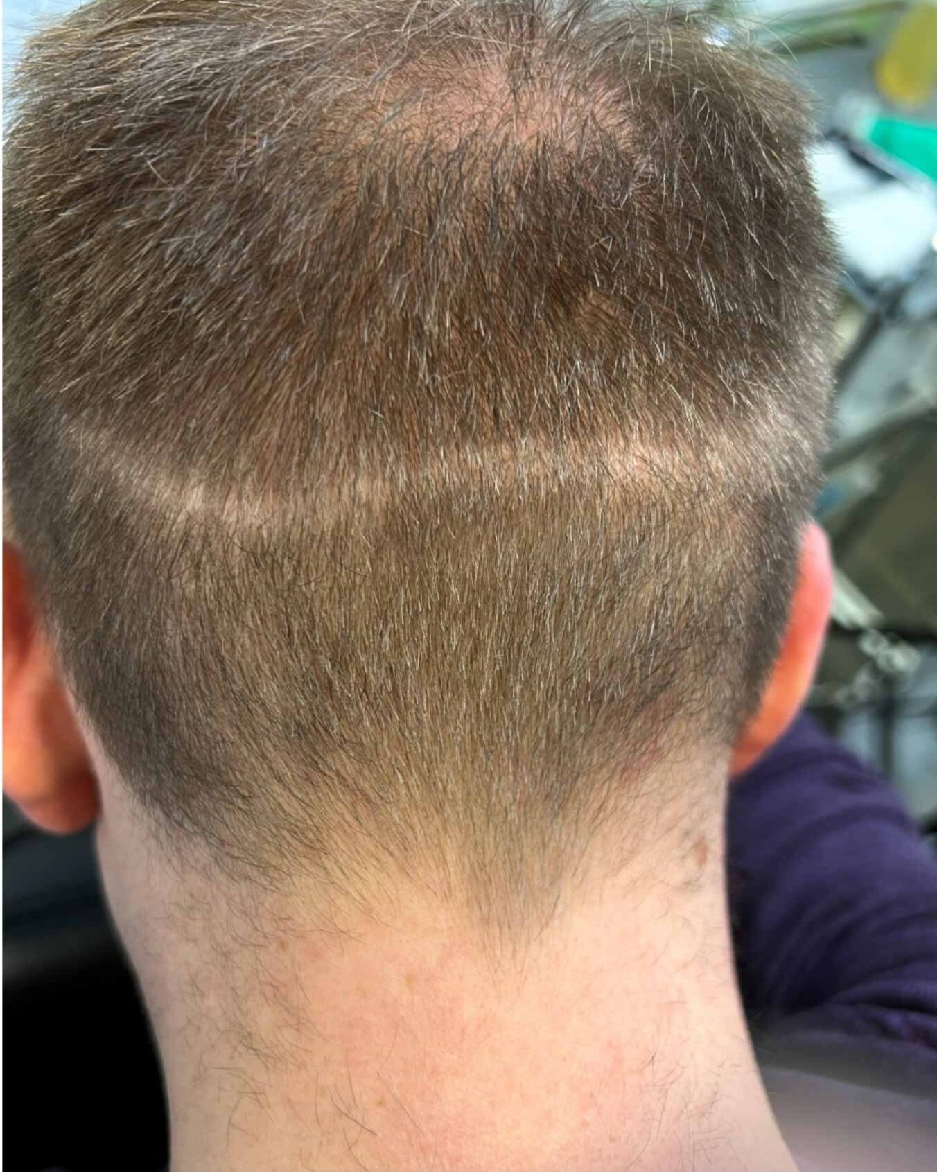 FUT Hair Transplant scar camouflage. Cosmetic and Mediical Tattoo by Dasha. Permanent makeup and reconstructive tattoo, scalp micro-pigmentation in Christchurch, New Zealand