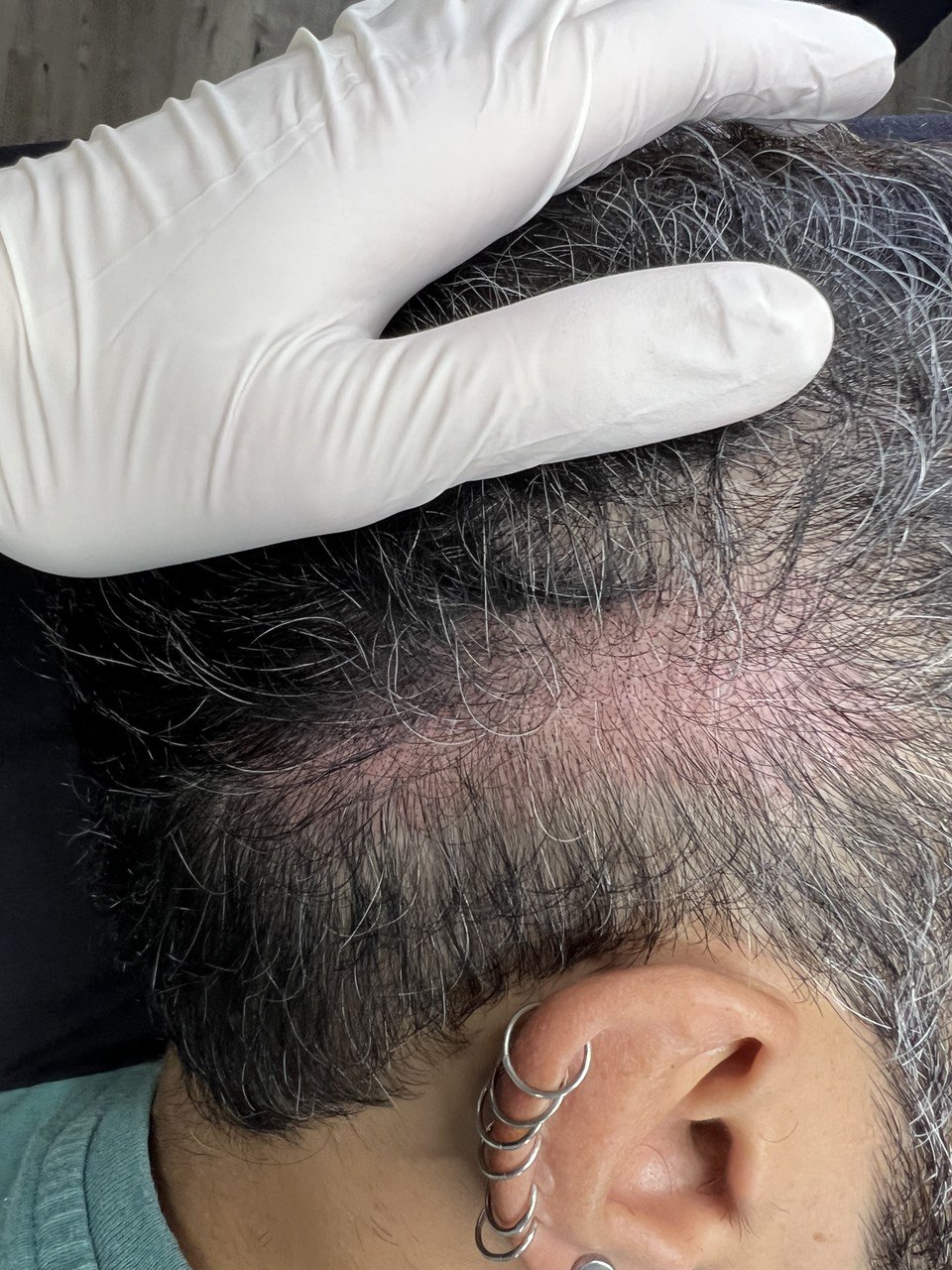 FUT Hair Transplant Camouflage (SMP). Cosmetic and Mediical Tattoo by Dasha. Permanent makeup and reconstructive tattoo, scalp micro-pigmentation in Christchurch, New Zealand