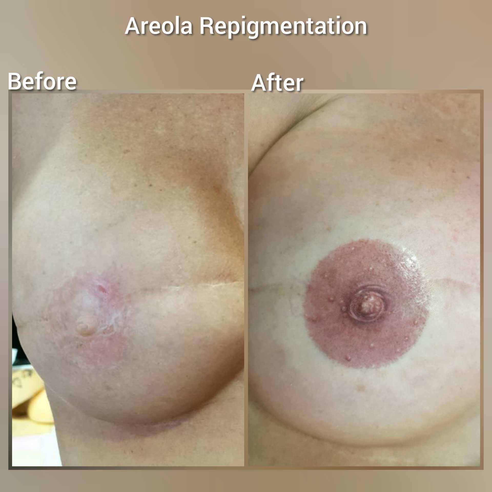 3D Areola Repigmentation,Medical Tattoo. Cosmetic and Mediical Tattoo by Dasha. Permanent makeup and reconstructive tattoo, scalp micro-pigmentation in Christchurch, New Zealand
