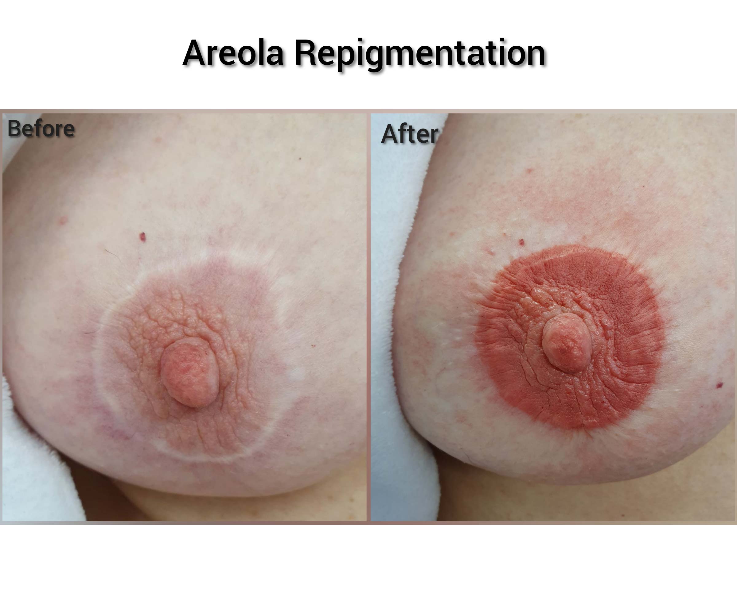 Areola Repigmentation. Cosmetic and Mediical Tattoo by Dasha. Permanent makeup and reconstructive tattoo, scalp micro-pigmentation in Christchurch, New Zealand