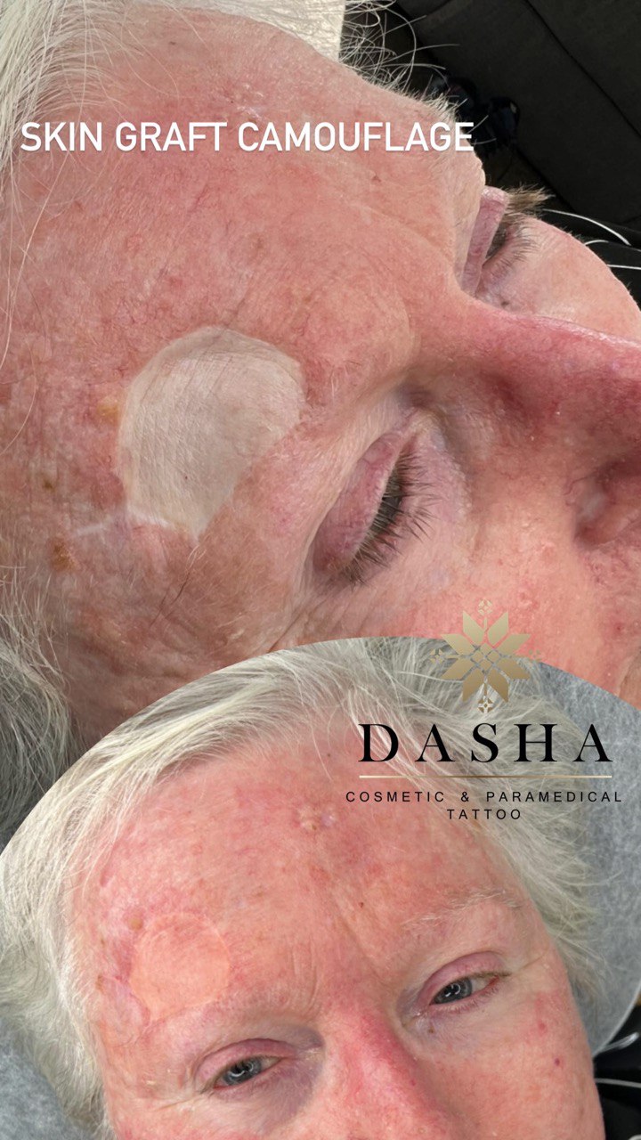 Skin Graft Camouflage. Cosmetic and Mediical Tattoo by Dasha. Permanent makeup and reconstructive tattoo, scalp micro-pigmentation in Christchurch, New Zealand