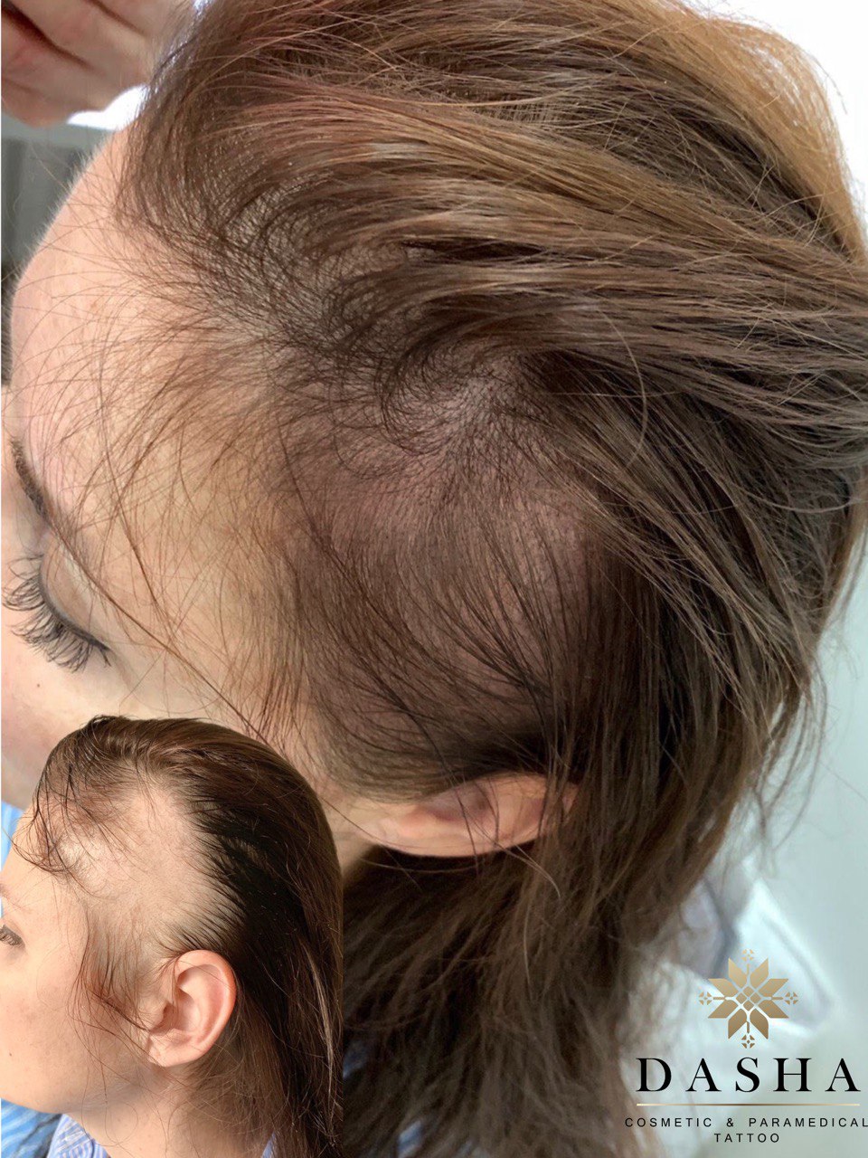 Alopecia Areata SMP. Cosmetic and Mediical Tattoo by Dasha. Permanent makeup and reconstructive tattoo, scalp micro-pigmentation in Christchurch, New Zealand
