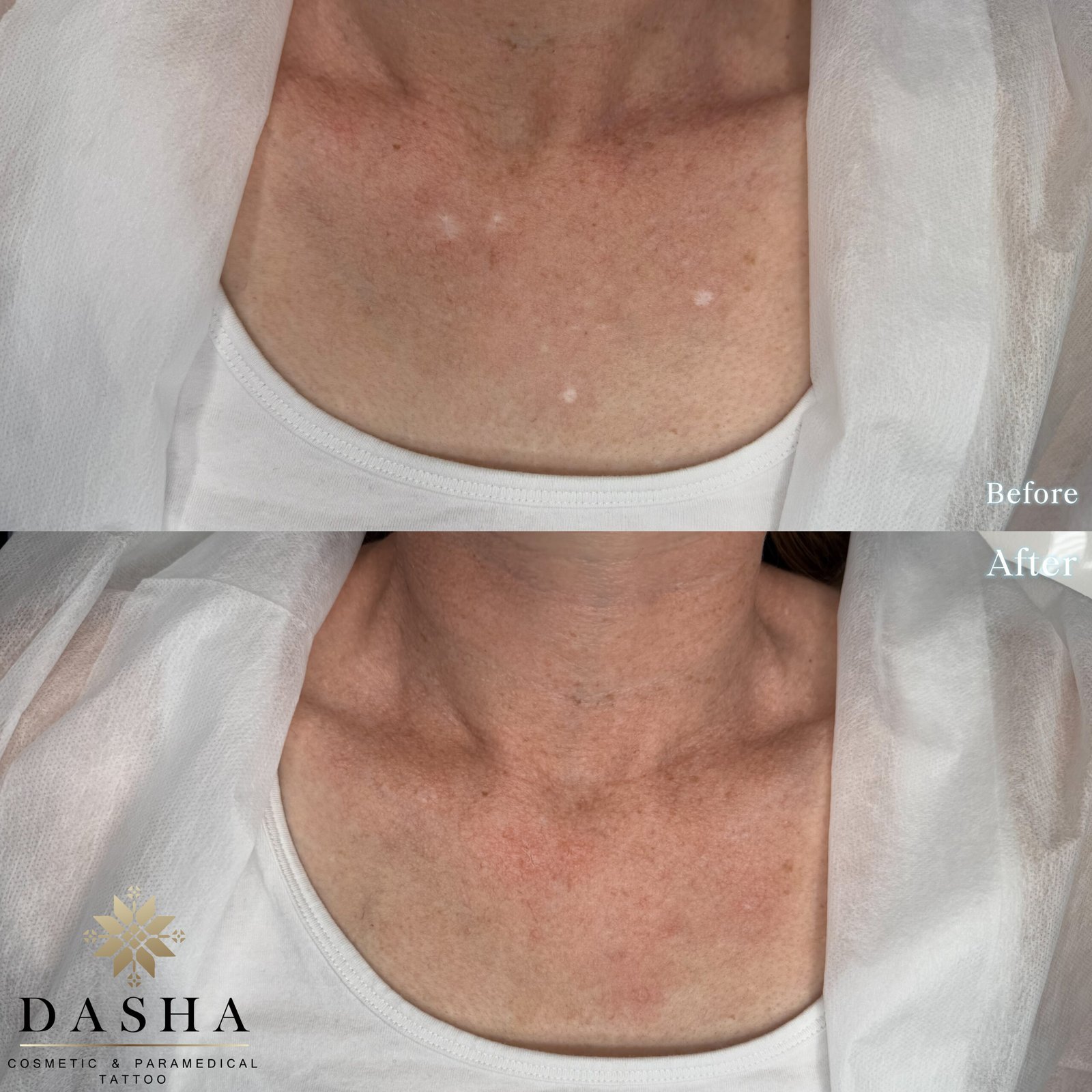 Acne Scar Camouflage Tattoo