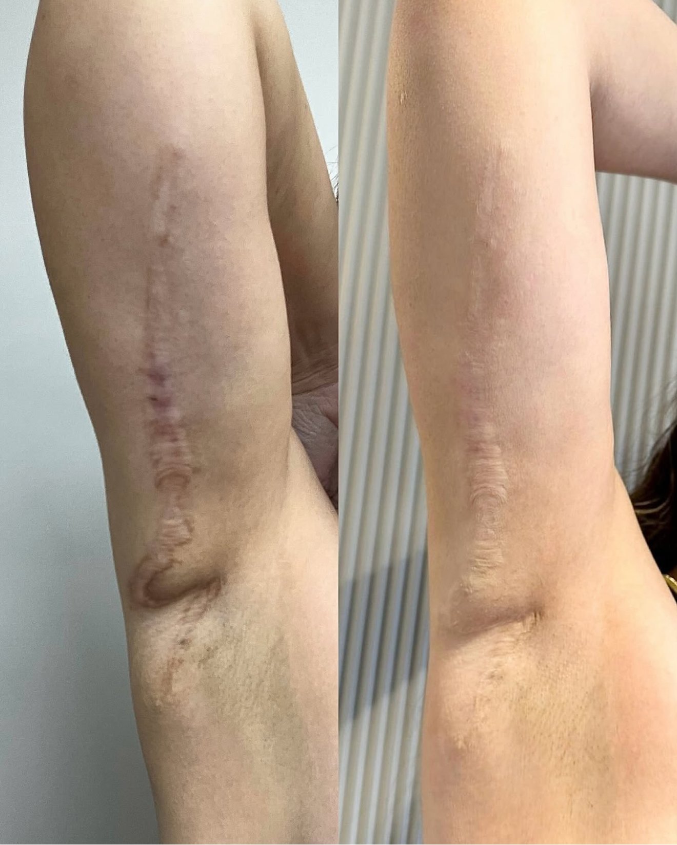 Upper arm surgery scar. Cosmetic and Mediical Tattoo by Dasha. Permanent makeup and reconstructive tattoo, scalp micro-pigmentation in Christchurch, New Zealand