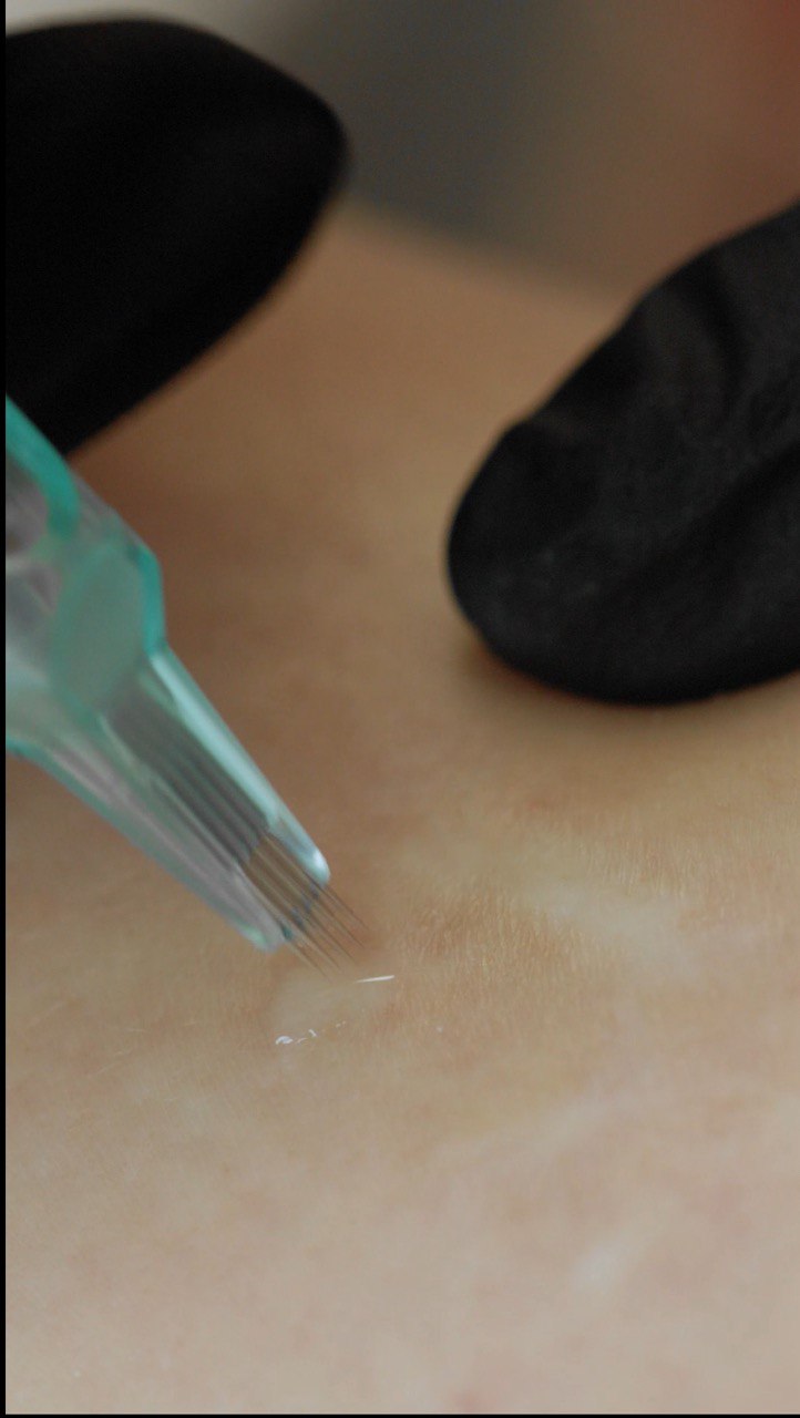 Inkless Scars and Stretch Mark Removal & Revision (ISR). Cosmetic and Mediical Tattoo by Dasha. Permanent makeup and reconstructive tattoo, scalp micro-pigmentation in Christchurch, New Zealand