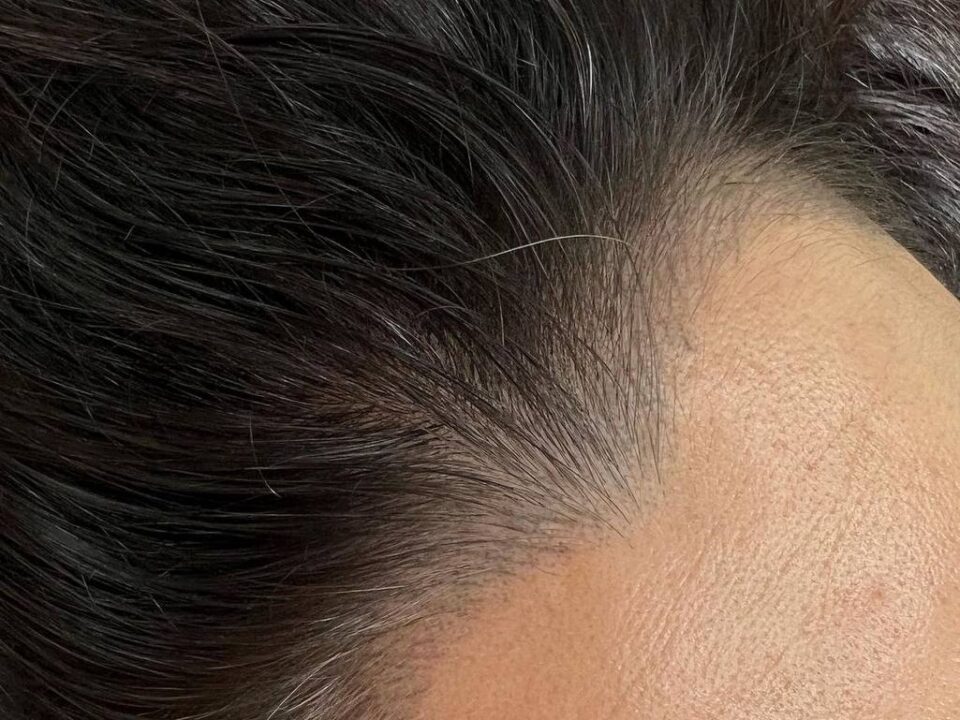 Women’s Hairline Restoration with Scalp Micropigmentation. Cosmetic and Mediical Tattoo by Dasha. Permanent makeup and reconstructive tattoo, scalp micro-pigmentation in Christchurch, New Zealand