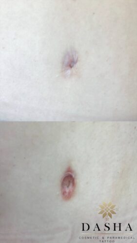 Belly Button Reconstruction Tattoo. Cosmetic and Mediical Tattoo by Dasha. Permanent makeup and reconstructive tattoo, scalp micro-pigmentation in Christchurch, New Zealand