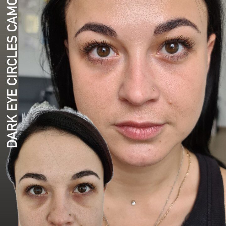 Dark Eye Circles Camouflage. Cosmetic and Mediical Tattoo by Dasha. Permanent makeup and reconstructive tattoo, scalp micro-pigmentation in Christchurch, New Zealand