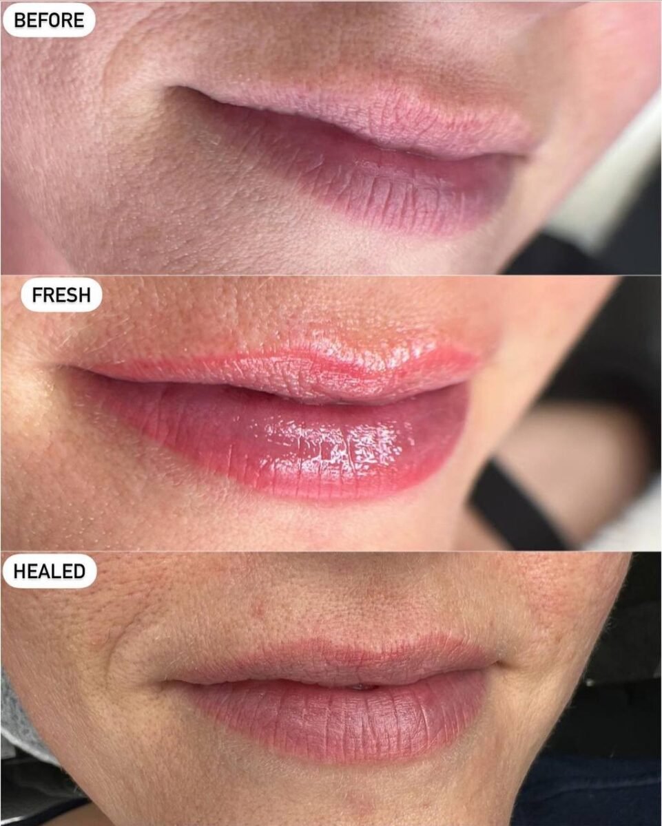 Lip Outline Cosmetic Tattoo | Cosmetic & Medical Tattoo by Dasha