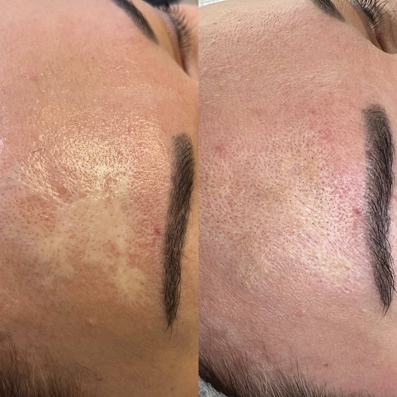 Scar Camouflage Medical Tattoo. Cosmetic and Mediical Tattoo by Dasha. Permanent makeup and reconstructive tattoo, scalp micro-pigmentation in Christchurch, New Zealand