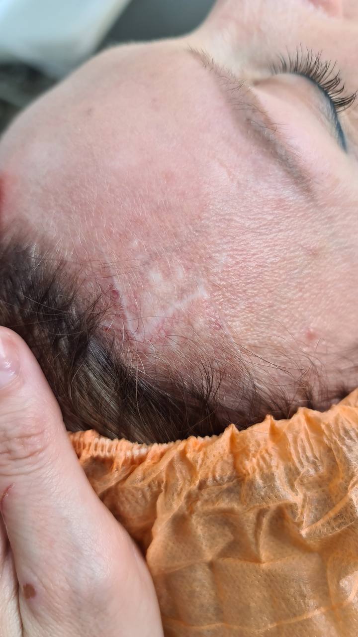 Scar Camouflage, Medical Tattoo. Cosmetic and Mediical Tattoo by Dasha. Permanent makeup and reconstructive tattoo, scalp micro-pigmentation in Christchurch, New Zealand