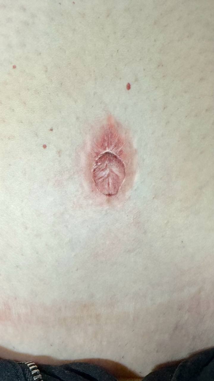 Belly Button Reconstruction Tattoo. Cosmetic and Mediical Tattoo by Dasha. Permanent makeup and reconstructive tattoo, scalp micro-pigmentation in Christchurch, New Zealand