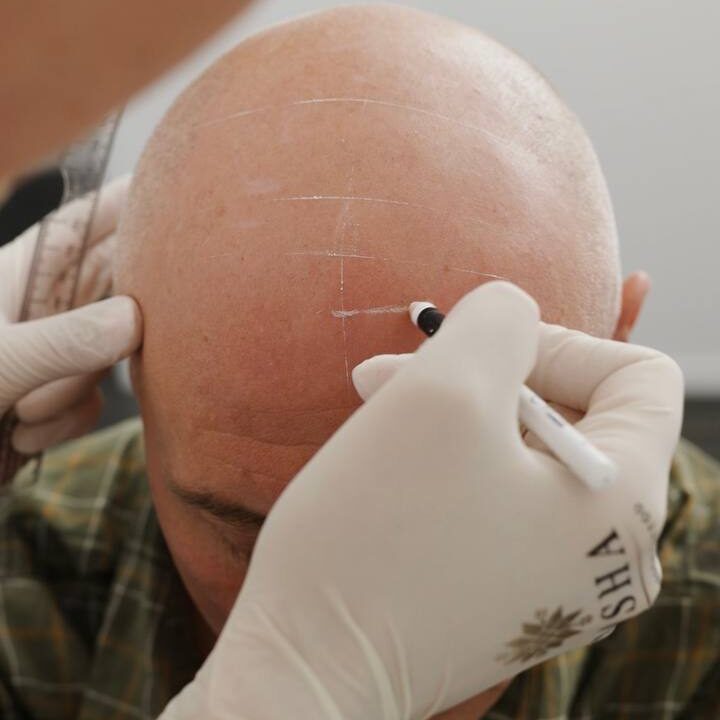 Scalp Micropigmentation in Christchurch: Cost, Process, Results & FAQ. Cosmetic and Mediical Tattoo by Dasha. Permanent makeup and reconstructive tattoo, scalp micro-pigmentation in Christchurch, New Zealand
