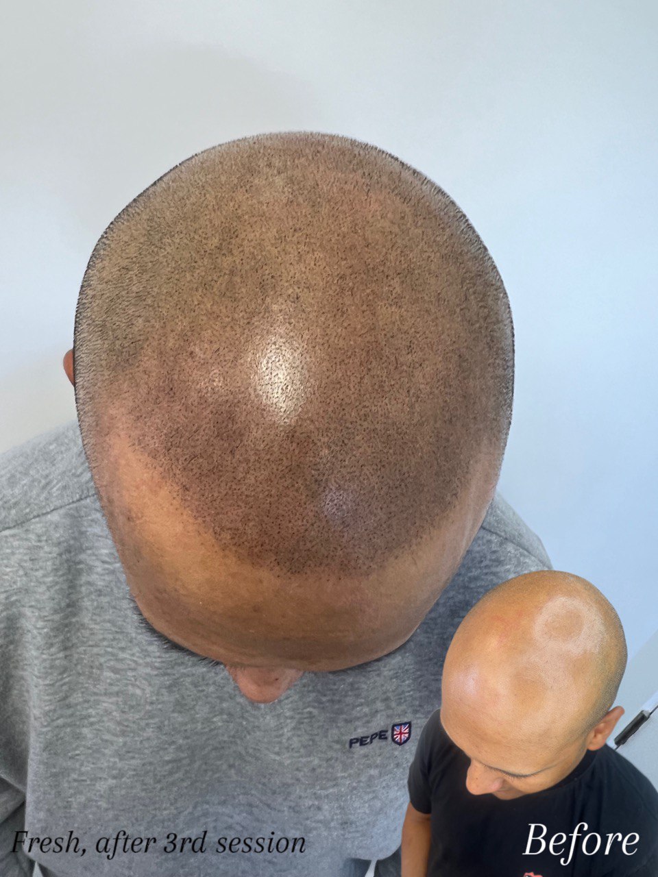 Scalp MicroPigmentation (SMP). Cosmetic and Mediical Tattoo by Dasha. Permanent makeup and reconstructive tattoo, scalp micro-pigmentation in Christchurch, New Zealand