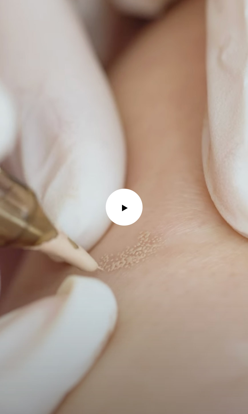 Inkless Scar & Stretch Marks Removal & Revision (ISR). Cosmetic and Mediical Tattoo by Dasha. Permanent makeup and reconstructive tattoo, scalp micro-pigmentation in Christchurch, New Zealand