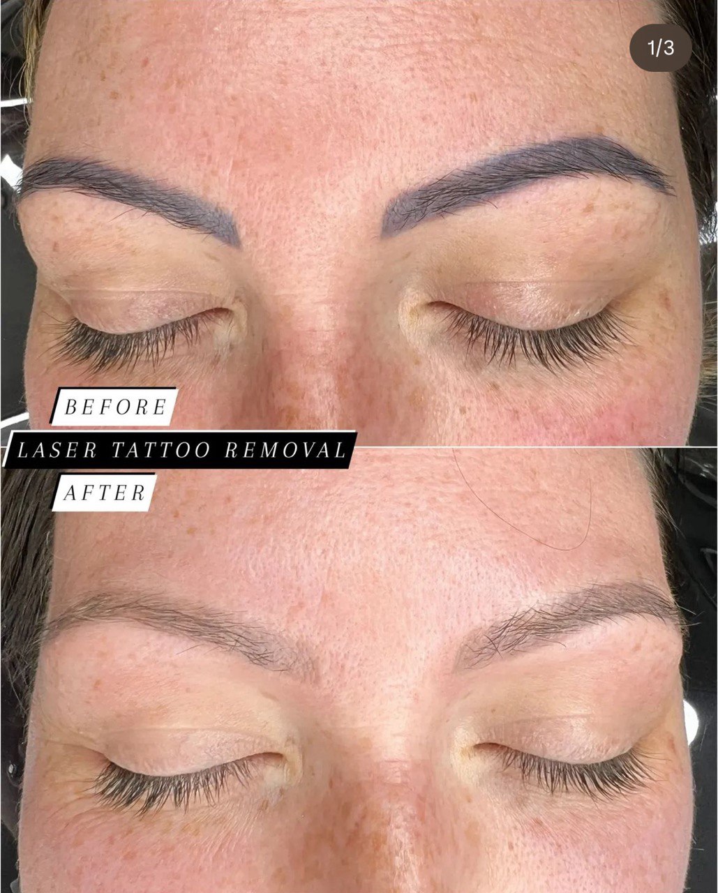 Brows Laser Tattoo Removal. Cosmetic and Mediical Tattoo by Dasha. Permanent makeup and reconstructive tattoo, scalp micro-pigmentation in Christchurch, New Zealand