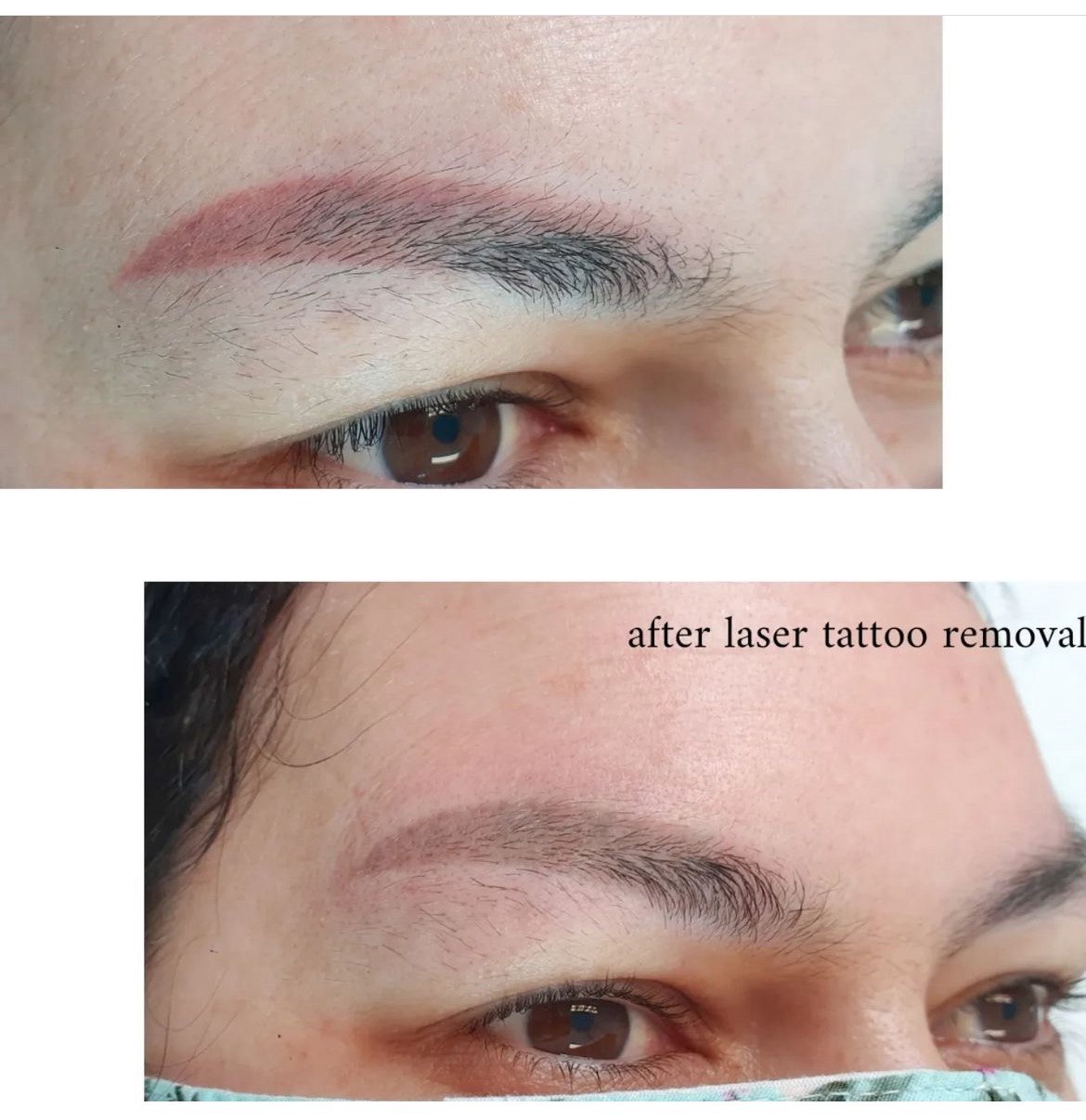 NdYag Laser Tattoo Removal.. Cosmetic and Mediical Tattoo by Dasha. Permanent makeup and reconstructive tattoo, scalp micro-pigmentation in Christchurch, New Zealand
