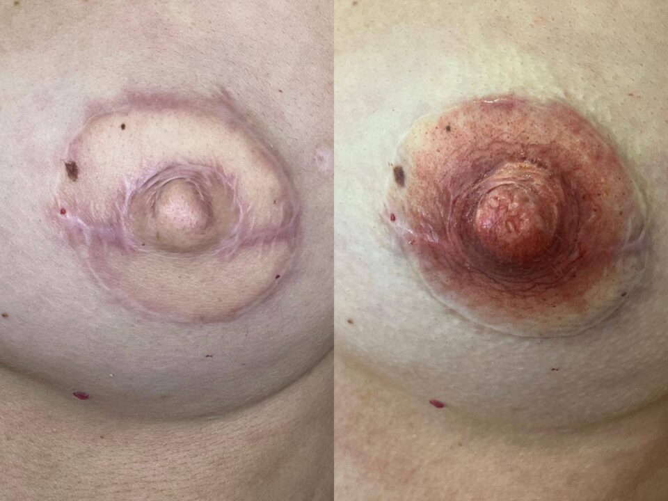 Nipple Tattoo. Cosmetic and Mediical Tattoo by Dasha. Permanent makeup and reconstructive tattoo, scalp micro-pigmentation in Christchurch, New Zealand