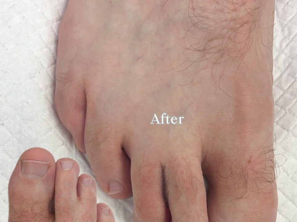 Syndactyly, Webbed Toes. Cosmetic and Mediical Tattoo by Dasha. Permanent makeup and reconstructive tattoo, scalp micro-pigmentation in Christchurch, New Zealand