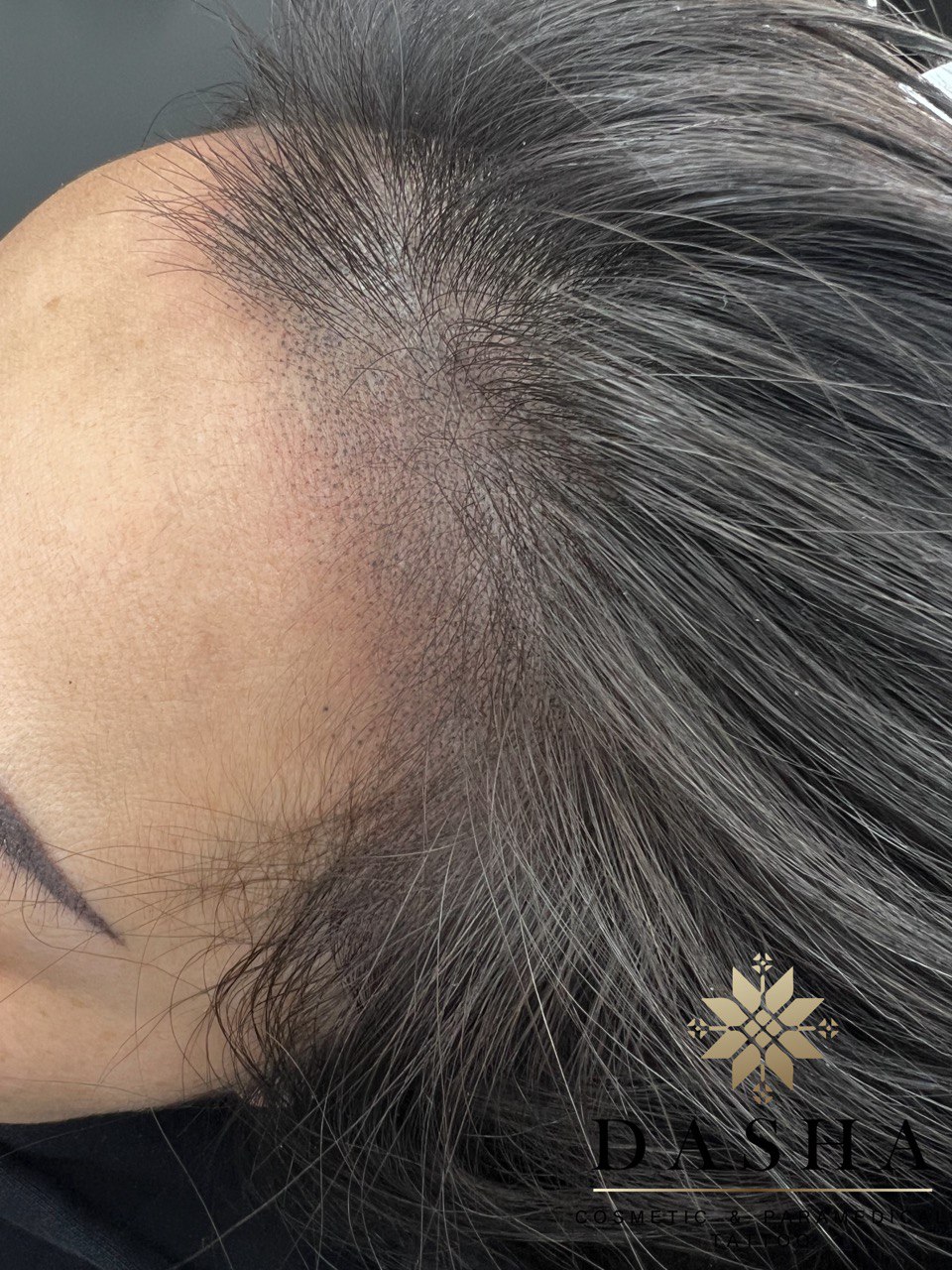 Hairline Density SMP. Cosmetic and Mediical Tattoo by Dasha. Permanent makeup and reconstructive tattoo, scalp micro-pigmentation in Christchurch, New Zealand