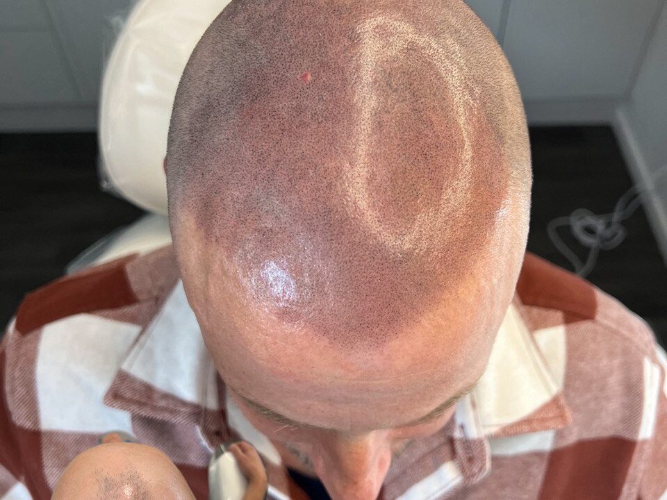 SMP Scalp MIcropigmentation Dasha Cosmetic Tattoo Christchurch New Zealand