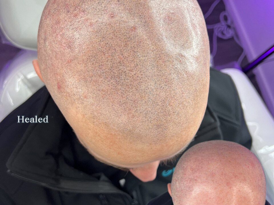 Scalp Micropigmentation SMP. Cosmetic and Mediical Tattoo by Dasha. Permanent makeup and reconstructive tattoo, scalp micro-pigmentation in Christchurch, New Zealand