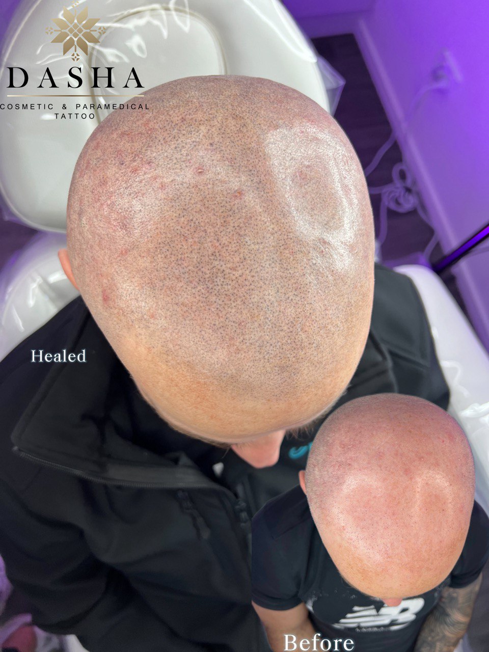 Scalp Micropigmentation SMP. Cosmetic and Mediical Tattoo by Dasha. Permanent makeup and reconstructive tattoo, scalp micro-pigmentation in Christchurch, New Zealand