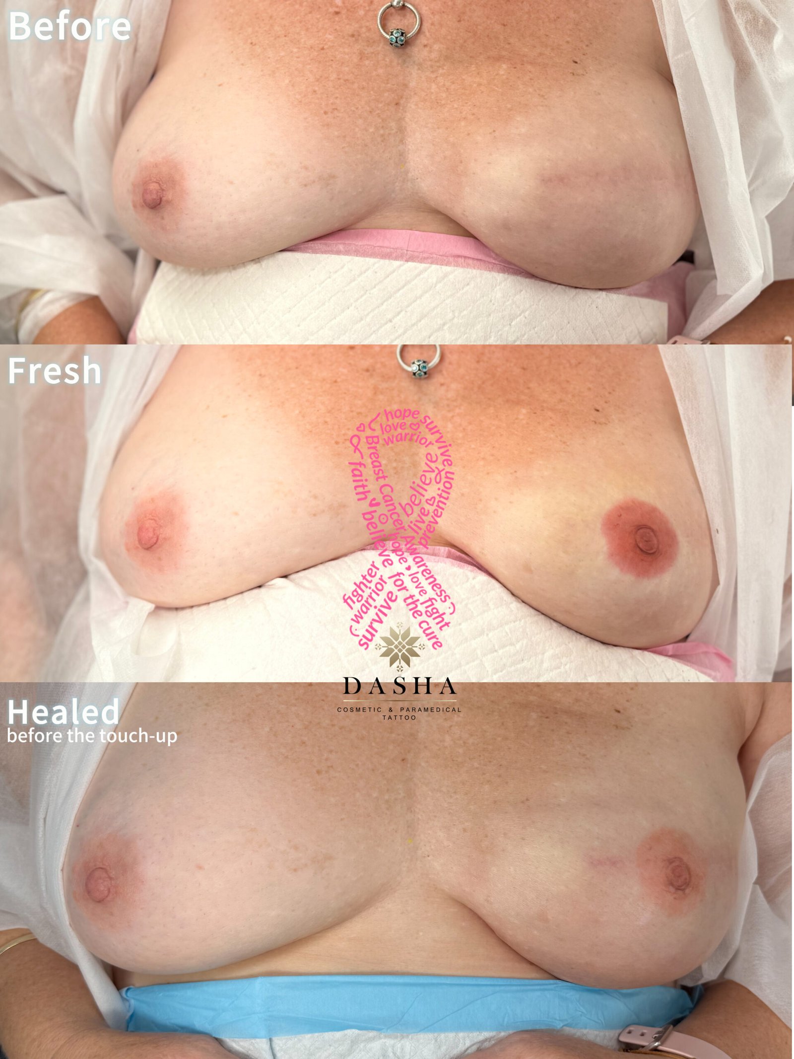 3D Nipple Tattoo. Cosmetic and Mediical Tattoo by Dasha. Permanent makeup and reconstructive tattoo, scalp micro-pigmentation in Christchurch, New Zealand