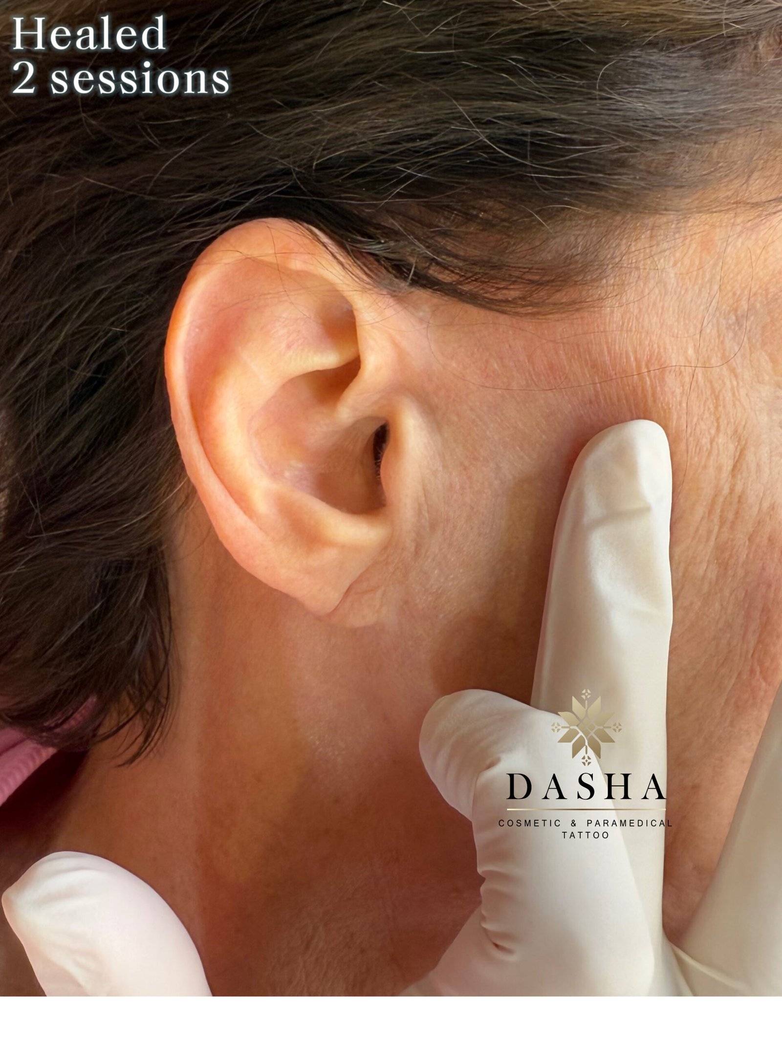 Face-Lift Scar Camouflage. Cosmetic and Mediical Tattoo by Dasha. Permanent makeup and reconstructive tattoo, scalp micro-pigmentation in Christchurch, New Zealand
