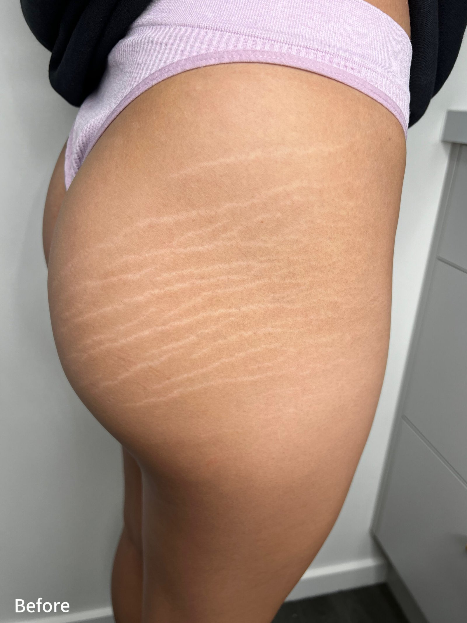 Stretch Marks Camouflage. Cosmetic and Mediical Tattoo by Dasha. Permanent makeup and reconstructive tattoo, scalp micro-pigmentation in Christchurch, New Zealand