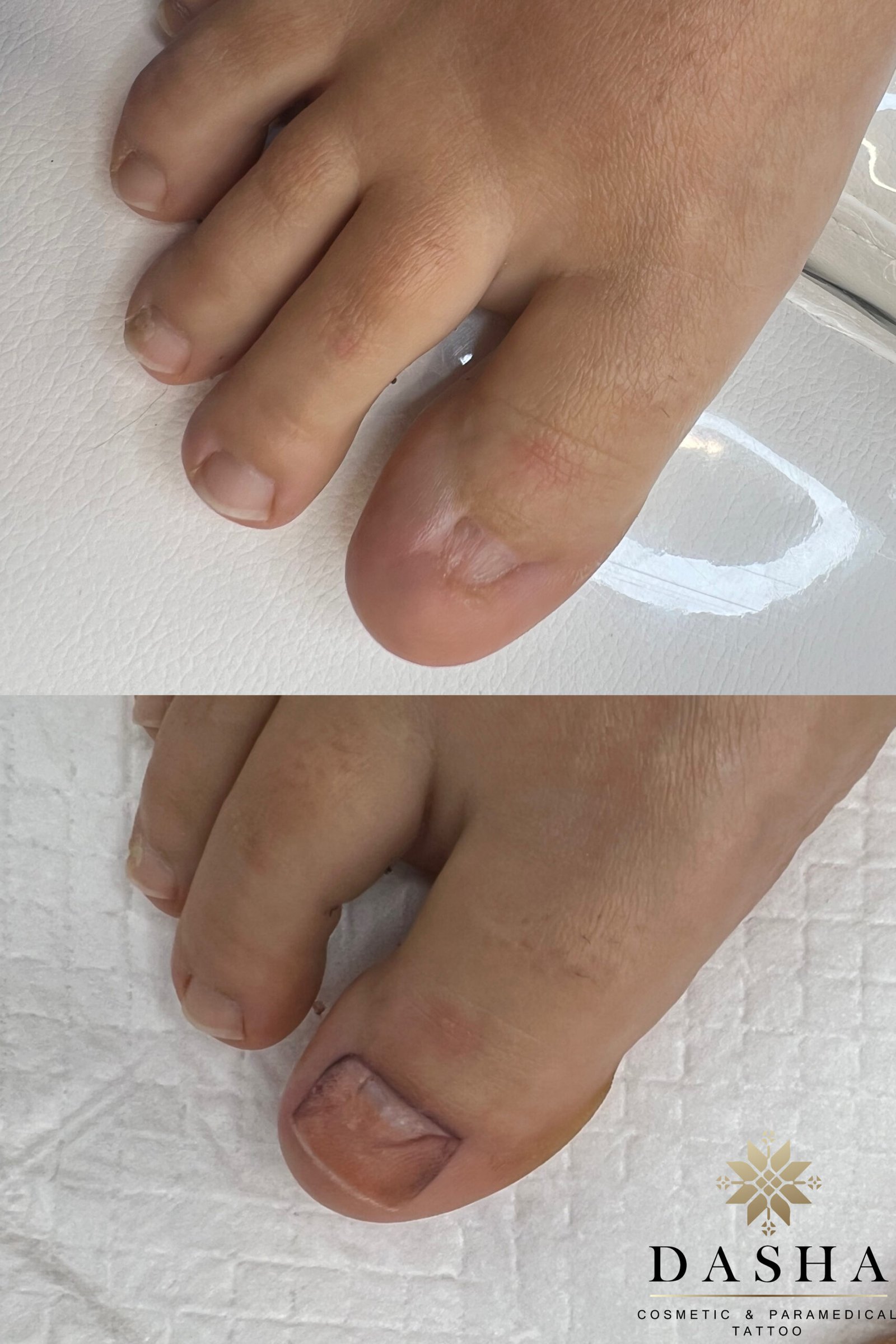 Nail Bed Reconstruction Tattoo.