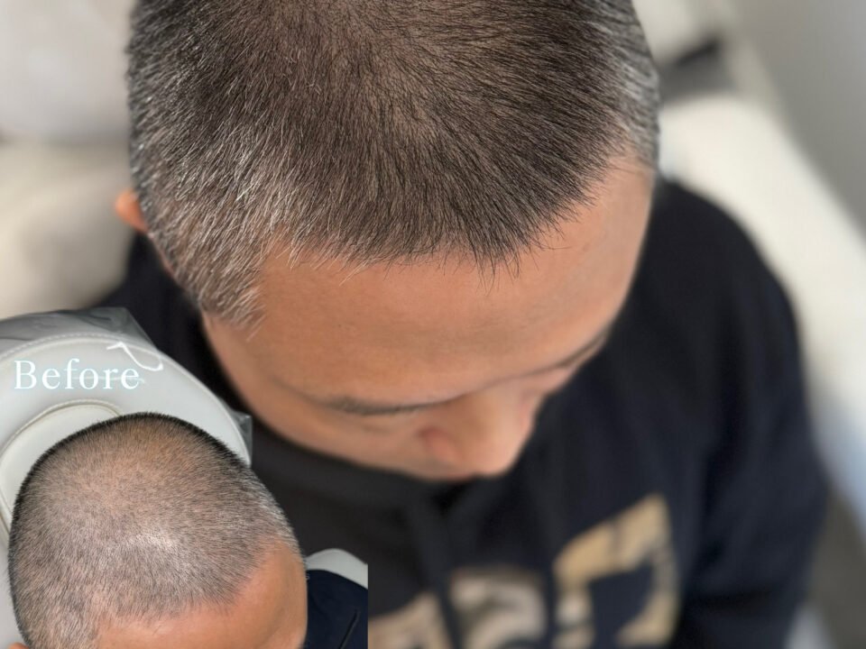Scalp Micropigmentation SMP. Cosmetic and Mediical Tattoo by Dasha. Permanent makeup and reconstructive tattoo, scalp micro-pigmentation in Christchurch, New Zealand
