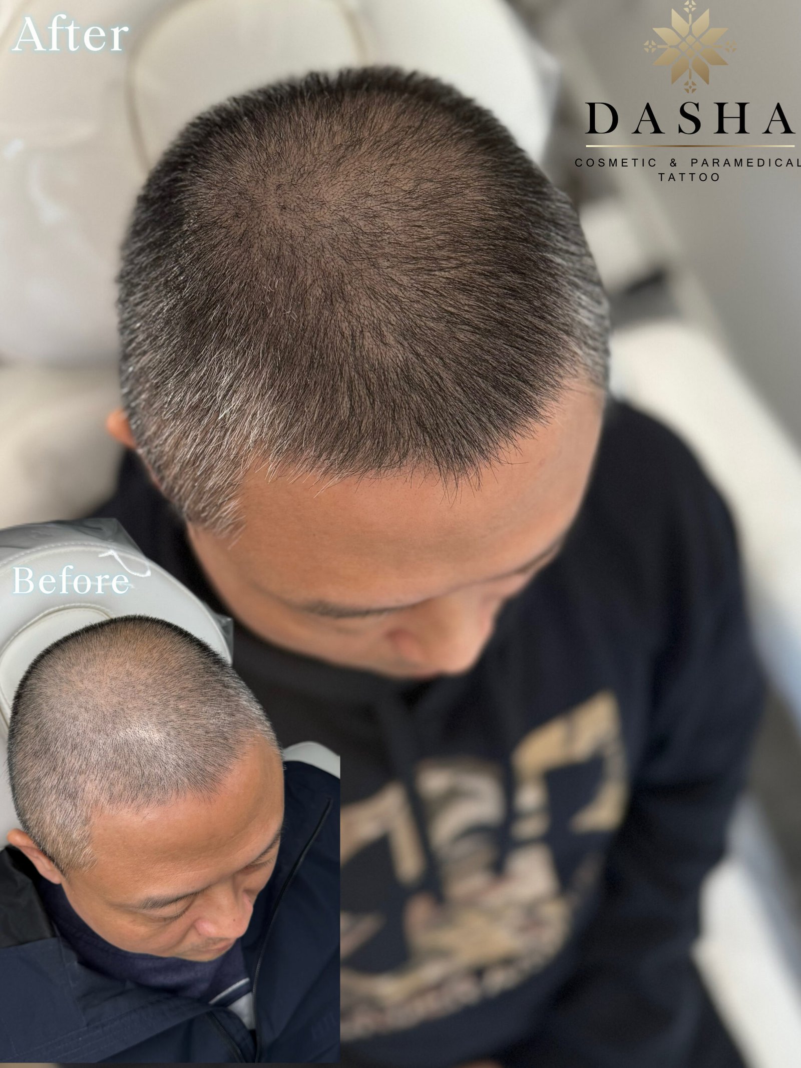 Scalp Micropigmentation SMP. Cosmetic and Mediical Tattoo by Dasha. Permanent makeup and reconstructive tattoo, scalp micro-pigmentation in Christchurch, New Zealand