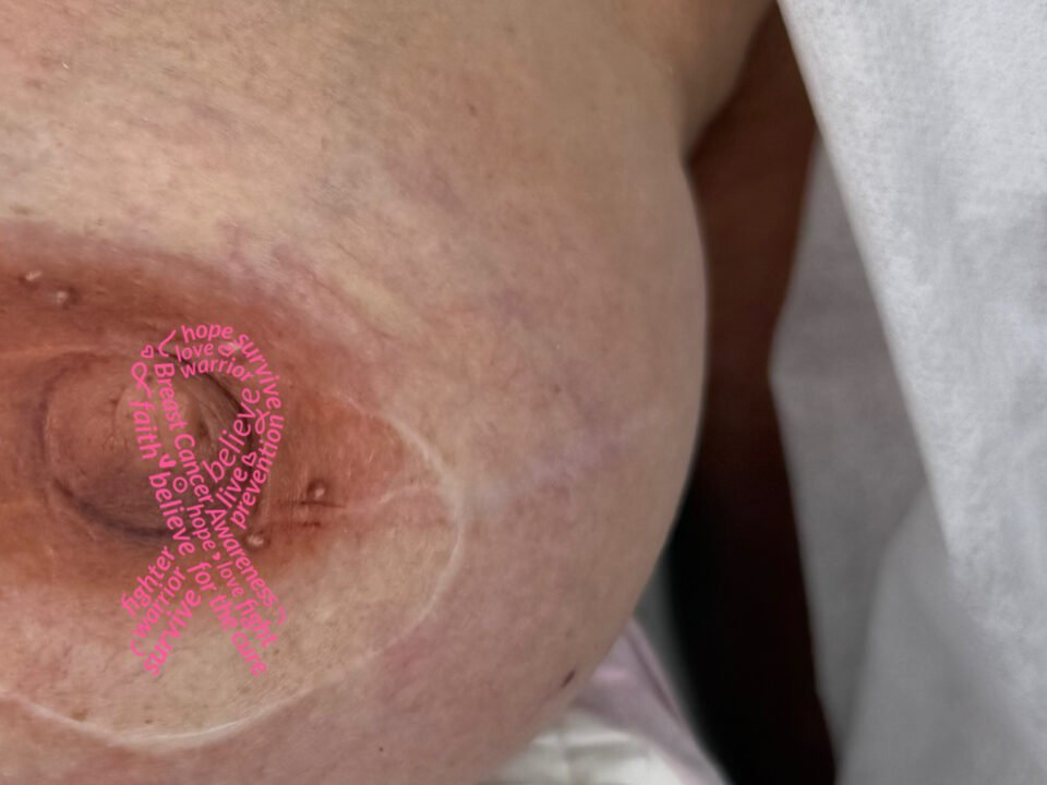 3D Nipple Tattoo. Cosmetic and Mediical Tattoo by Dasha. Permanent makeup and reconstructive tattoo, scalp micro-pigmentation in Christchurch, New Zealand